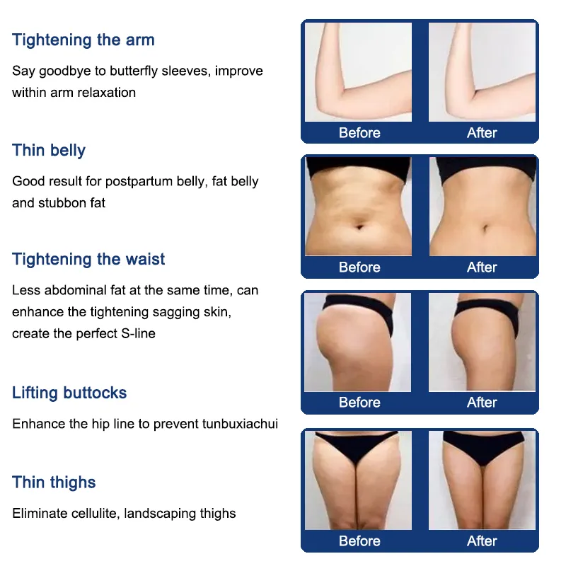 Nicht-invasive Liposonix 2022 Modell Fettreduktions-Schlankheitsmaschine 2 Kartuschen 8 mm 13 mm Körper schlanke Cellulite-Entfernung Muskelverbrennung