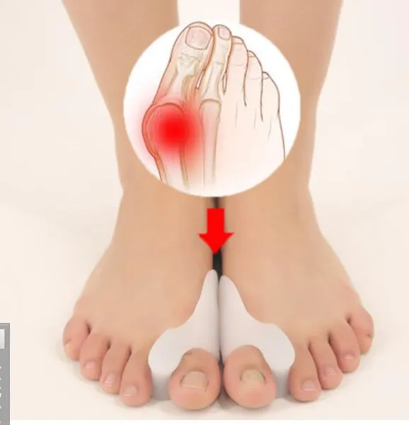 O envio gratuito de Silicone separador Toe tratamento do pé de cuidados de saúde de hálux valgo órtese Toes valgo corrector