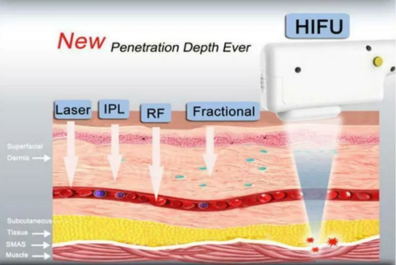 Macchina dimagrante la rimozione delle rughe del lifting facciale ad ultrasuoni focalizzati ad alta intensità professionale HIFU con 3/5 teste viso e corpo