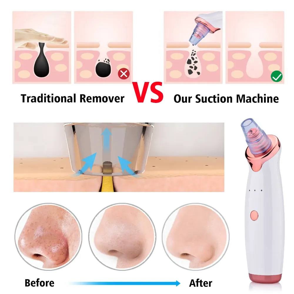 Pore-Cleaner-Blackhead-Remover-Electric-Vacuum-Suction-Face-Pimple-Acne-Comedone-Extractor-Facial-Pores-Cleaner-Skin (1)