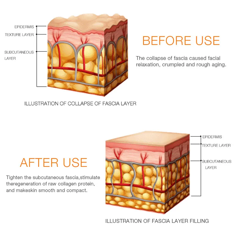 Équipement RF Mini HIFU Machine Ultra Machine Produits de soins de la peau R F Fadiofrecuencia Lifting du visage Anti-rides Thérapie par ultrasons