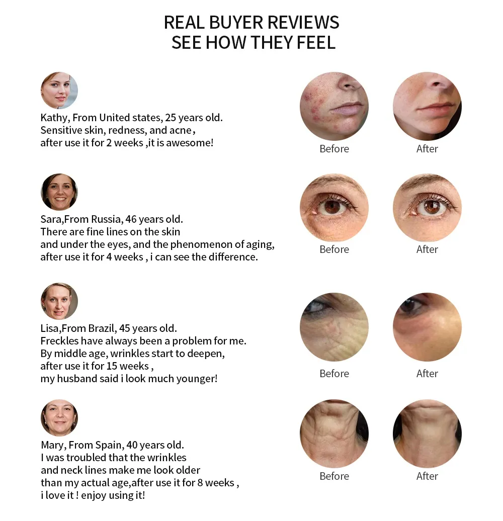 جهاز تجميل الوجه IPL ميزوثيرابي Electroporation للوجه بموجات الراديو RF جهاز الفوتون للعناية بالبشرة جهاز تجميل شد الوجه وإزالة التجاعيد