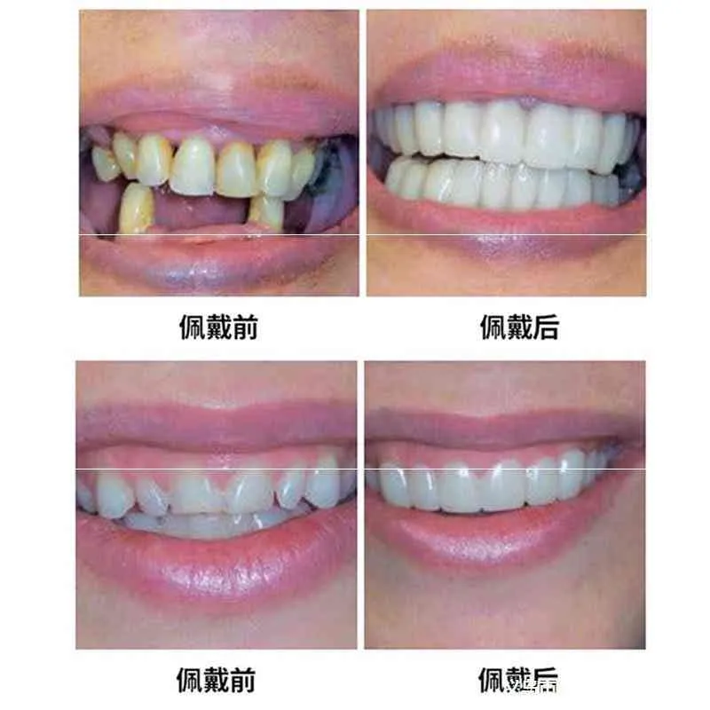 Покрытие между зубами, чтобы съесть настоящие зубы, артефакт, резец, временная паста для отсутствующих зубов, истинный и ложный ортодонтический протез, протез 2391719