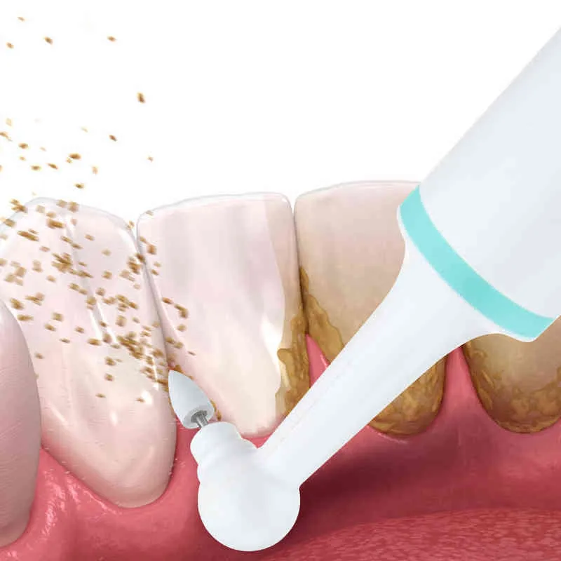 Отбеливание зубов электрическое лакер -лак для глубокого чистящего камня Снятие стоматологического налета зубного налета