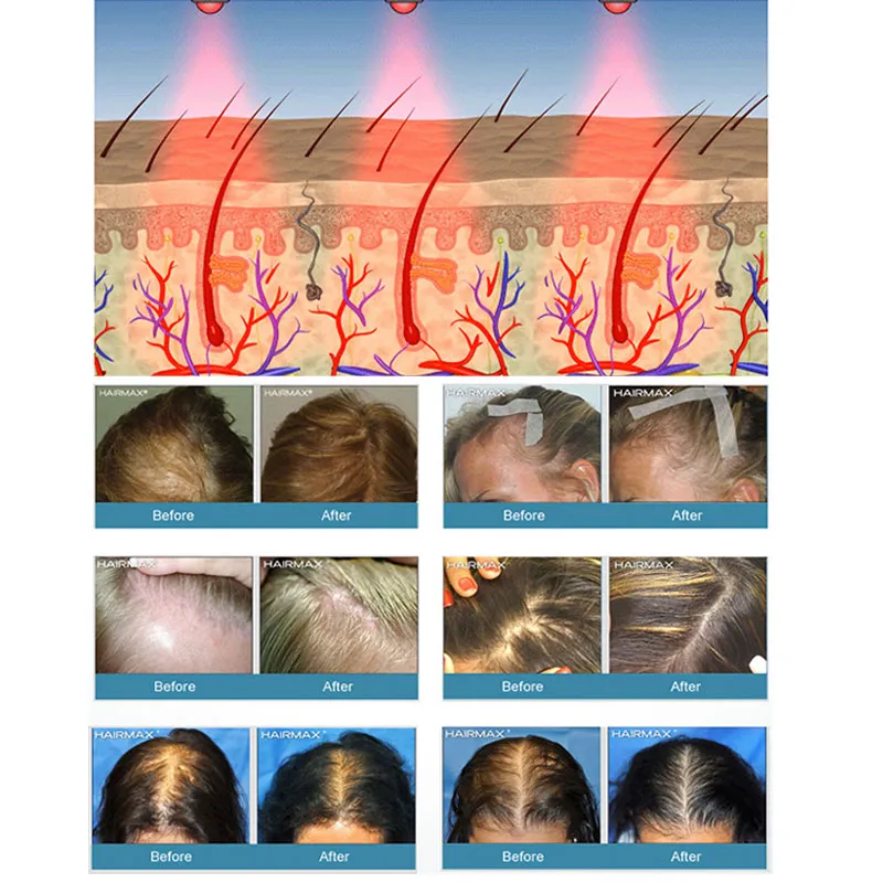 Nouveau Laser Thérapie Croissance Des Cheveux Casque Anti Perte De Cheveux Dispositif Traitement Pour Homme Femmes LLLT Laser Repousse Des Cheveux Cap Équipement De Massage