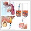 Portatile dimagrante pressione magnetica extracorporea terapia ad onde d'urto attrezzature mediche/macchina per alleviare il dolore corporeo/trattamento del dolore onda d'urto