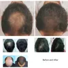 Machine professionnelle de traitements de repousse des cheveux Led thérapie par la lumière Laser équipement de traitement de perte de cheveux Machine de croissance des cheveux au Laser
