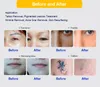 Южная Корея импортированных световых руководств ARM Hight Power Age Pigment Freckle Темные пятна Удаление угревой рубкой Сманка Удаление татуировки Удаление машины