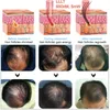 Hög effektiv lllt hår förlustbehandling 650nm laser hår tillväxtterapi maskin för hår regrowth lazer utrustning