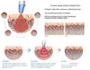 traitement chirurgical de lifting de vibration de rf machine de couteau de graisse cellulite réduisant la peau de massage serrant la machine de régime