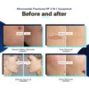 fractional microneedle Acne Treatment fractional micro needle Face Lifting RF Equipment operation video