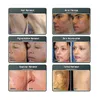 IPL OPT 레이저 제모 어두운 피부 ND YAG LAZER 문신 Remova Machine Elight Cignmentation Treatment Wrinkle 제거 2 년 보증 로고 사용자 정의