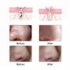 Visuell wifi kamera blackhead remover ansikte djupt näsa renare pore akne pimple borttagning vakuum ansikts rent hudverktyg