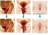 Tratamiento de ultrasonido para vagina Hifu Máquina de ajuste vaginal SMAS Ajuste de vagina HIFU vaginal 3.0 / 4.5 mm 10000 disparos cada dispositivo múltiple