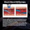 Équipement de massage de thérapie par ondes de choc à usage domestique Machine à ondes de choc de faible intensité Dispositif portatif de soulagement de la douleur de physiothérapie de dysfonctionnement érectile focalisé