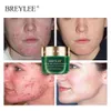 Breylee Acne Pimple Patch ACNE Tratamento Folhetos Folhetos Máscara Facial Acne Creme Essence Facial Skin Cuidados Pimple Removedor Ferramentas