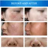 Hydra dermabrasion改善皮膚ディープケア酸素ジェットピールAqua PeelingRFしわ除去マルチ機能マシン