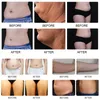 하이 엔드 기계 360 Cryolipolysis 지방 제거 슬리밍 냉동 치료 장치 Cryolipolysis RF Cavitation 배꼽 지방 제거