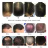 Apparecchiature per il trattamento della crescita dei capelli laser Macchine per il ripristino dei capelli con luce infrarossa lazer a diodi Mitsubishi Lampade da 260 pezzi