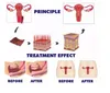 40W 4d fotona CO2 laser fractionné étroit resserrement vaginal équipement de beauté 10600nm élimination des cicatrices d'acné machine de rajeunissement de la peau