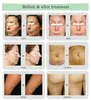 Salong Använd radiofrekvens RF Skin Dränta Anti-Wrinkle Micro Needle Fraktionell RF Skönhetsmaskin för ansiktslyftning Stretch Mark Acne Removal