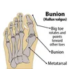 バニオン整形外科用靴下のトウの区切り文字補正足の痛みを和らげる