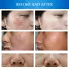 다기능 페이셜 스킨 케어 머신 Dermabrasion 피부 Resurfacing 얼굴 깨끗한 처리 바이오 마이크로 렉트 양식