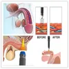 3 in1 Shockwave Terapia Tecar Fisioterapia e Máquina EMS para melhor alívio da dor Celulite Reduzir com o tratamento Ed