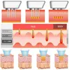 الذهب microneedle rf مايكرو إبرة كسور الراديو التردد الجلد تجديد الوجه رفع آلة الجمال