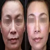 Клиника SPA Salon Используйте RF Beauty Device Радиочастотное омоложение кожи Монополярная RF-машина