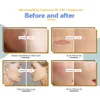 NEW Fractional rf Microneedle machine Skin Rejuvenation Mico Needle face Care Acne Scar Stretch Mark Removal Treatment