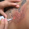 Profissional Pigmento Permanente Acne cicatriz e YAG Máquina de remoção de tatuagem de tatuagem Laser de sobrancelha 1064nm 532nm Descasco de carbono Q comutação q