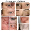 Portable RF Equipment Facial Beauty Salon Use Ozone Plasma Pen Freckle Remover Skin Rejuvenation Machine 2 in 1 Acne Wrinkle Removal Device