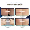 Radiofrekvens Microneedling Stretch Marks Removal Secret RF Microneedle Fraktionell hud Dra åt rynkor Reduktion Acne ärrbehandling