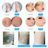 Q Switch ND YAG Laser Machine Picosecond Birth Mark Tattoo Removal Laser Beauty Machine 5 Sonder för pigmentavlägsnande