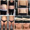 Cryolipoliza Fat Freeze Maszyna Lipolaser Personal Personal Cryoterapia Lipo Laser Ultrasonic Cavitation RF Sprzęt piękności