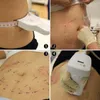 Ultrashape liposonix real grau médica lipohifu com cartuchos de 13mm 8mm hifu máquina de emagrecimento para perda de peso de emagrecimento de corpo rápido