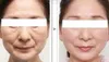 Épilateur pour le visage ipl rajeunissement de la peau ipl rf opt elight anti-âge épilateur indolore ipl