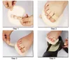 발 관리 Hallux Valgus 정형 외과 중족골 비뚤어진 겹치는 망치 발가락 교정기 교정기 발 마사지 정형 용품