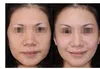 ipl opt élimination de l'acné équipement de beauté ipl épilation ipl pour peau foncée