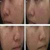 2021 nuovo laser CO2 frazionato vaginale stringere la macchina di bellezza per la rimozione dell'acne della cicatrice per il ringiovanimento della pelle per il salone CE