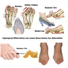 1 paar de nieuwste siliconen hallux Valgus Braces Grote gechallciled orthopedische correctie sokken tenen separator voeten zorg