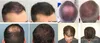 Оптовая продажа машина роста волос лазера диода самая новая хорошее качество лазер диода волос regrowth лазер диода для лечения выпадения волос