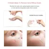 4 pièces dissolvant de points noirs acné bouton comédon extracteur Whitehead Kit d'outils de suppression pour hommes femmes soins du visage peau