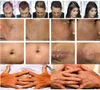 Erbio Fibra di vetro Laser frazionato 1550nm Attrezzatura per la bellezza Rimozione delle rughe/cicatrici da acne non ablativa Lifting del viso