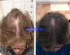 Laser hår snabb regrowth hjälm diod håravfall lösning anti håravfall behandling huvud massage lock