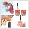 45mm profundidad energía penetra 14 piezas transmisores máquina de terapia de ondas de choque vertical onda de choque Fascitis Plantar tratamiento ED