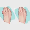 Vertvie Kvinnor Skor Tofflor Orthopedic Bunion Corrector Comfy Platform Ladies Casual Big Toe Correction Sandal