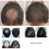 Hair regrowth 650nm Diode laser hair growth machine beauty tousle loss treatment