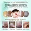RtopR mangue points noirs dissolvant nez masque traitement de l'acné pores bande lifting raffermissant Peeling T Zone soin huile-contrôle masque